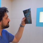 دکتر محمد حسین منوچهری - ایمپلنت دندان (6)