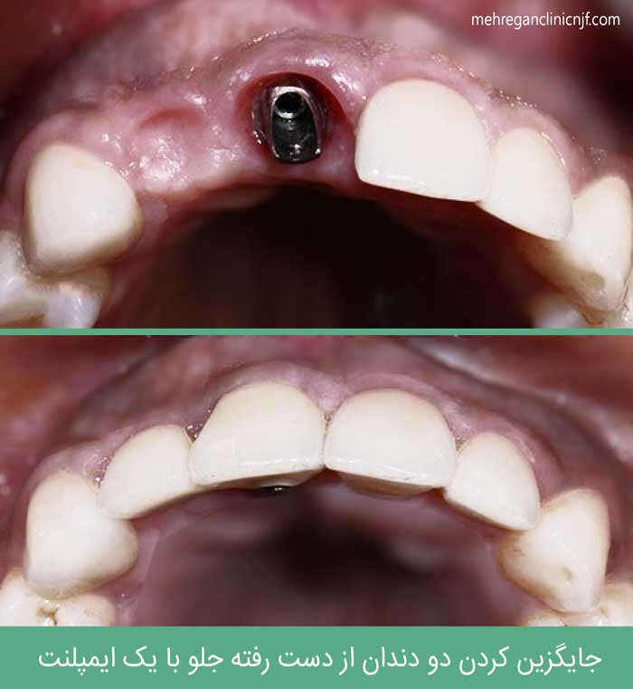 ایمپلنت دو دندان با یک پایه