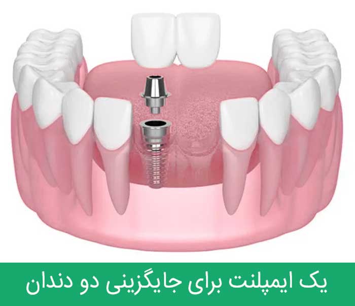 ایمپلنت دو دندان کنار هم از دندان های جلو