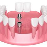 ایمپلنت دو دندان کنار هم، مزایا و معایب ایمپلنت یک پایه برای دو یا چند دندان