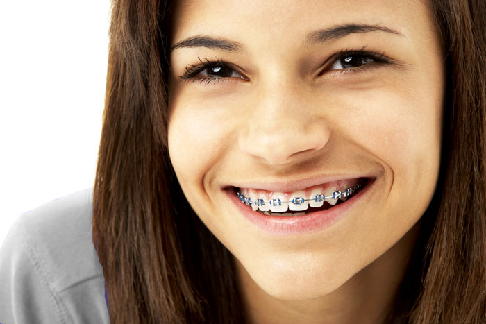Disadvantages- of- orthodontics- at -the- age -of- 30