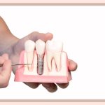 ایمپلنت دندان چیست؟【مزایا + قیمت + مراحل انجام + معایب احتمالی】