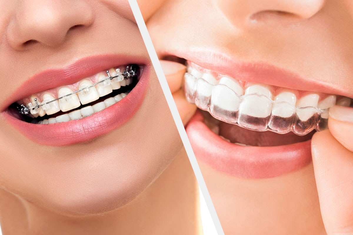 orthodontics-in-age-30-types-of-braces